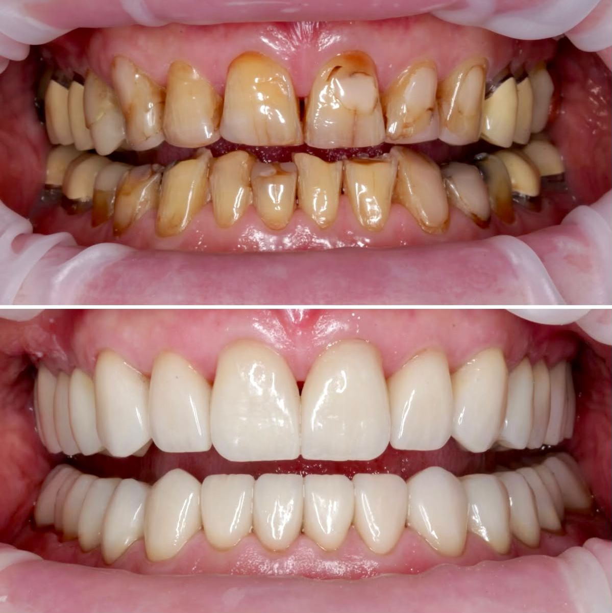 Full Mouth Rehabilitation