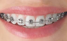 Dental Braces